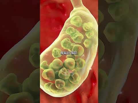 You CAN'T Get Gallstones On A High Fat Diet! (Doctor Explains) #shorts #short #shortvideo